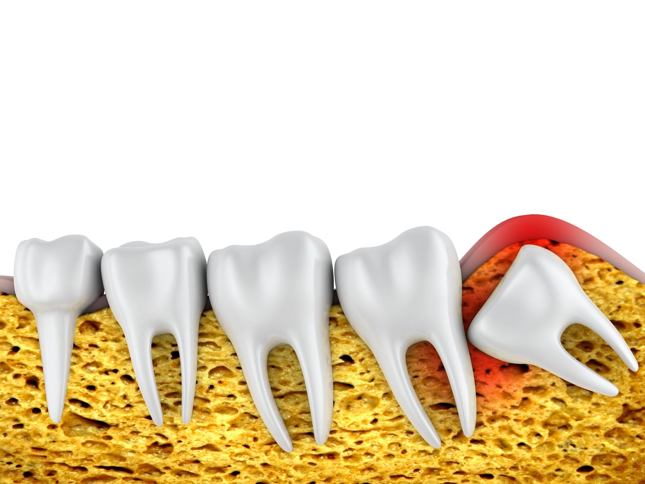 Preparing for Wisdom Teeth Extraction: What to Expect